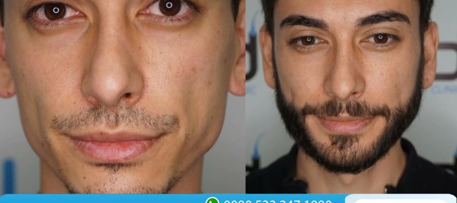 Video Thumbnail: 2800 Grafts Beard Transplant Before and After I Dr. Hakan Doganay TURKEY