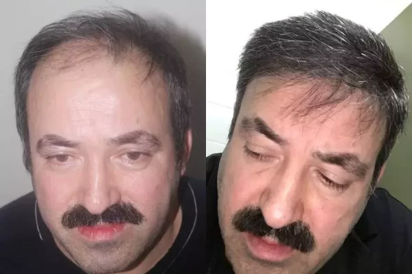 greffe cheveux 8000 greffons