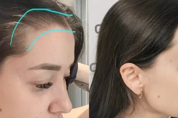 greffe de cheveux femme