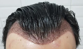 Tam tıraş gerektirmeyen saç ekimi, saçını korumak isteyen hastalar için ideal.